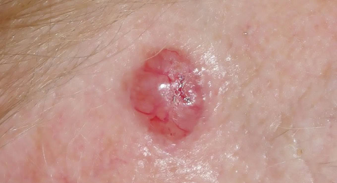 Basaalcelcarcinoom (BCC)