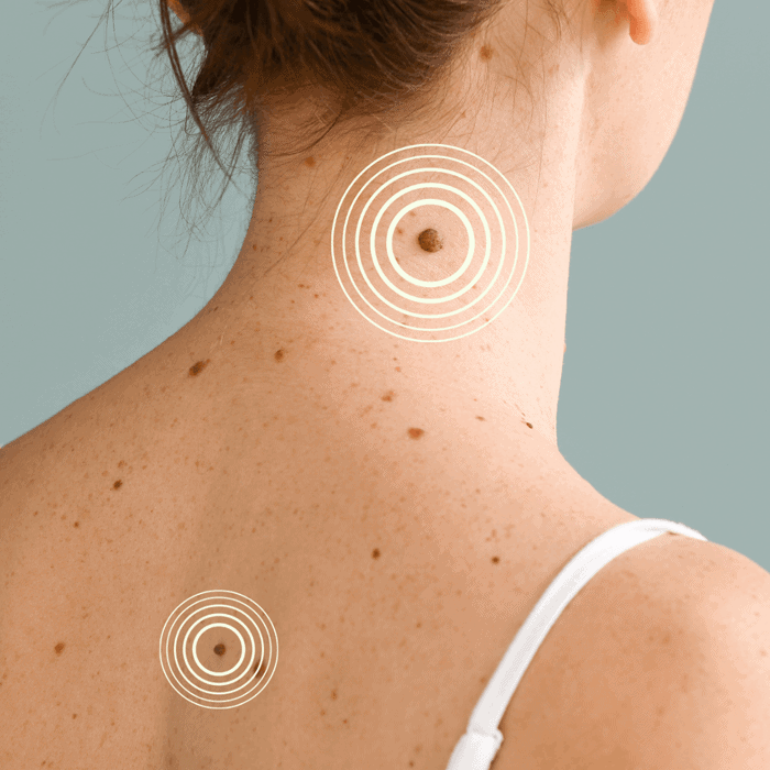 moedervlek huidkanker